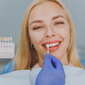 Скрыть недостатки: что нужно знать об установке виниров на зубы