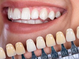 Спросили эксперта: какой самый простой способ отбелить зубы