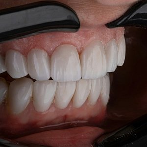Показать зубы: зачем и как проводят контурную пластику десен