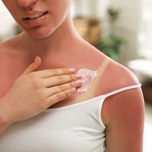 Как облегчить состояние кожи после солнечного ожога: руководство к действию