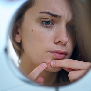 Оставьте кожу в покое: как избавиться от дерматилломании и перестать ковырять лицо Оставьте кожу в покое: как избавиться от дерматилломании и перестать ковырять лицо