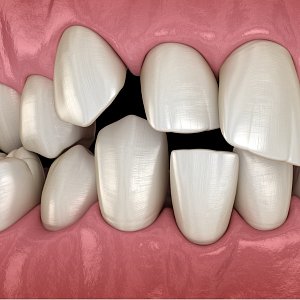 6 причин, почему зубы растут криво, и какие от этого могут быть последствия