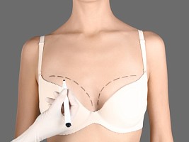 Липотрансфер груди: как улучшить внешний вид бюста с помощью собственного жира